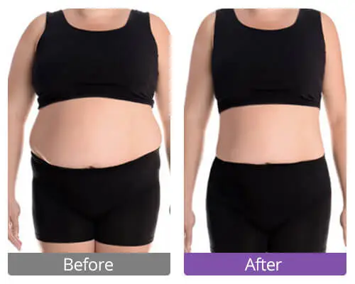 ultrasonic cavitation before and after thighs